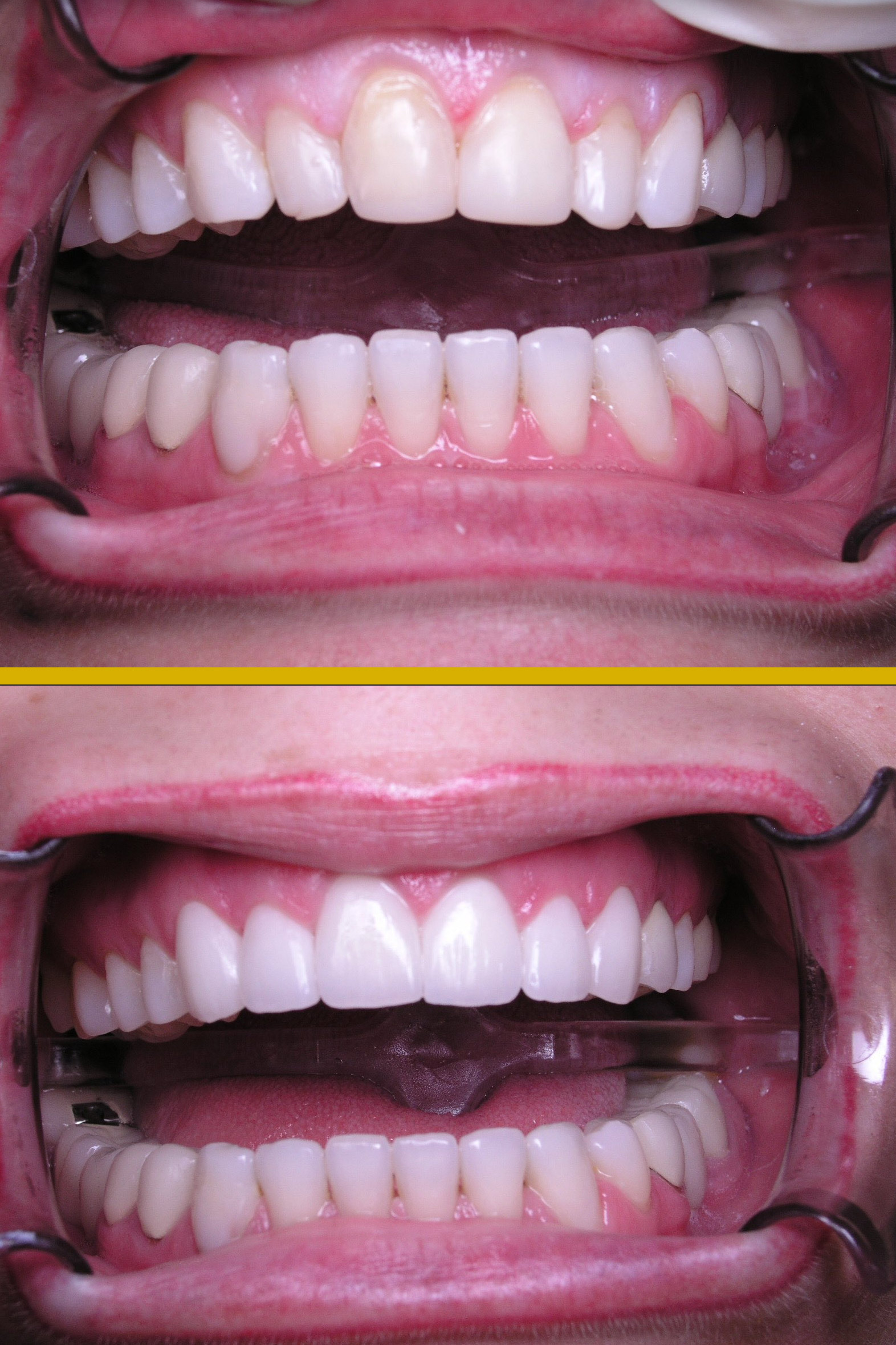 Before and after