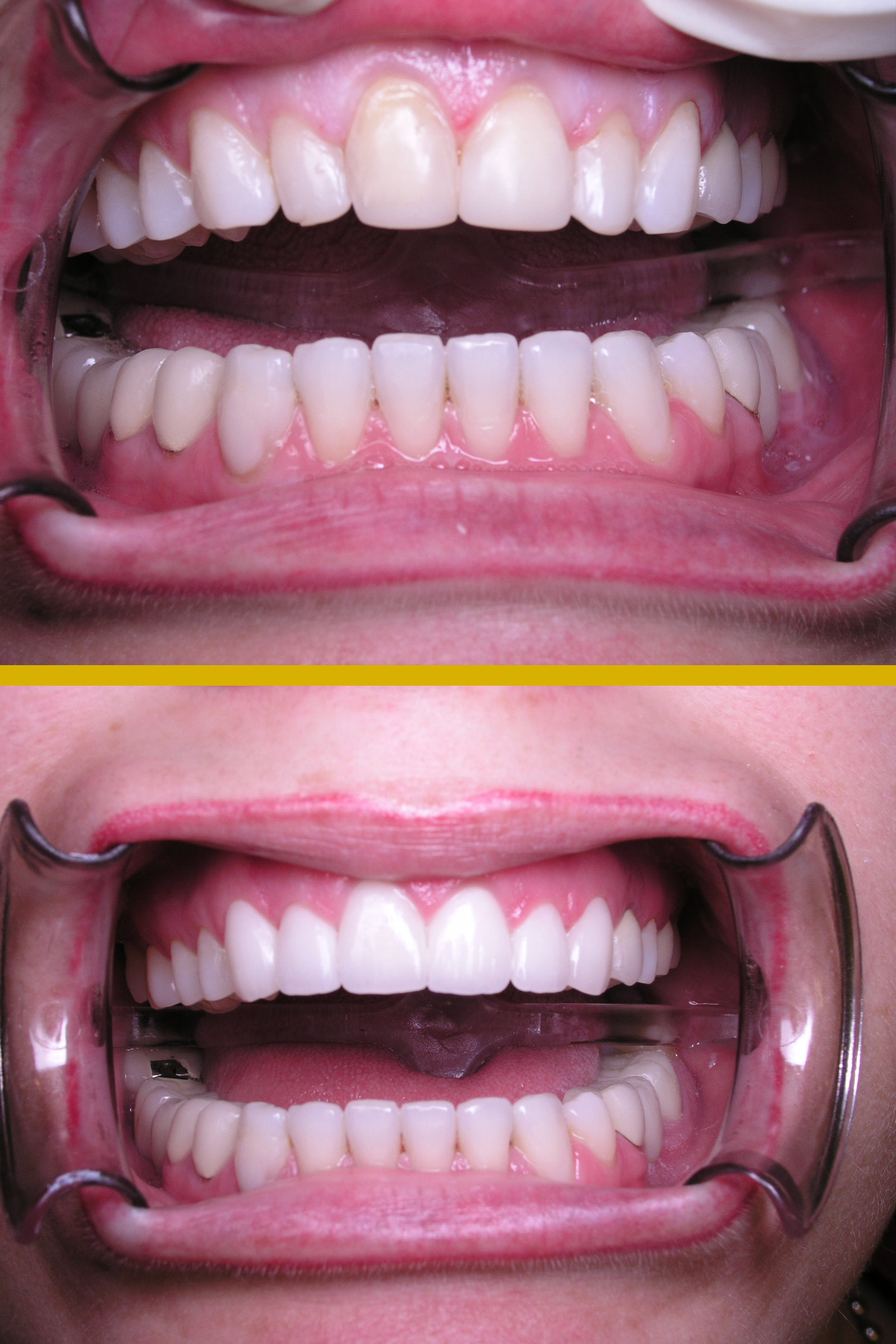 Before and after